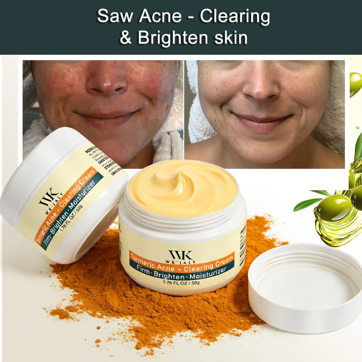 WK Jaly Moisturizing Skin Care Kit for Acne and Spots